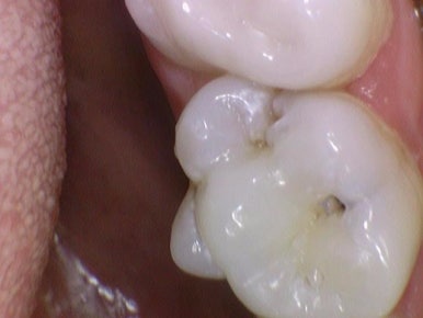 충정로 치과 인레이 해야한다고 들었는데 충치가 안보여요 관련 이미지 7