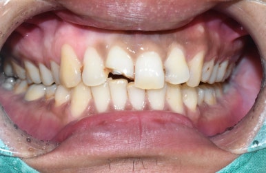 서울시청역 남대문 임플란트 대신에 앞니 브릿지를 한 케이스 관련 이미지 4