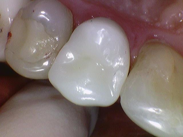 시청역치과, 신경치료 하고 크라운 꼭 해야하나요? 관련 이미지 6