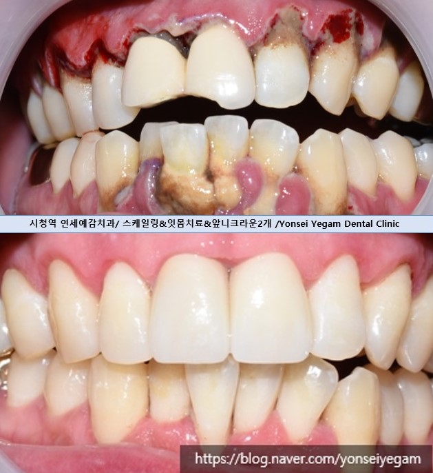 스케일링 처음 받는 분들도 많이 찾아오는 광화문 시청역 삼성본관 바로 앞 치과 관련 이미지 8