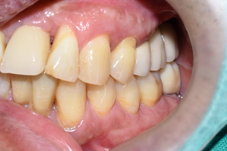 [서울시청역치과] 다른 치과에서 오래전에 한 임플란트가 흔들려요 &rarr;재수술 케이스 관련 이미지 10