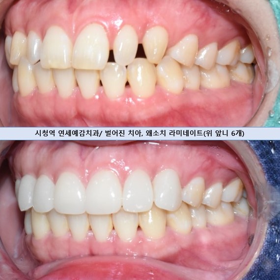 서울 시청역/서울역/ 벌어진 앞니, 왜소치 라미네이트 유명한 치과/ 전후 비교와 가격 관련 이미지 2