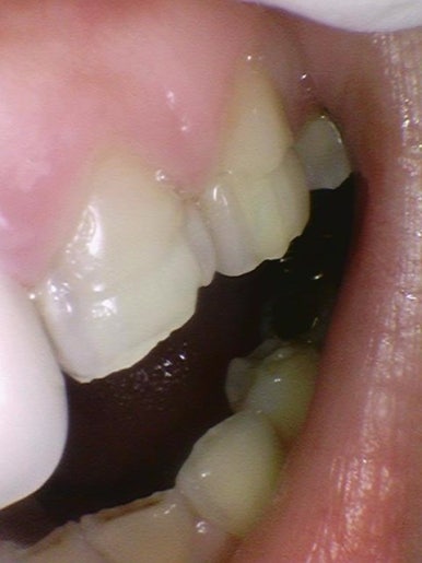 [시청역/광화문] 부식된 노란치아. 정말 하얀, 새하얀 치아로 만들고 싶어요 비용도 알려드려요 관련 이미지 6