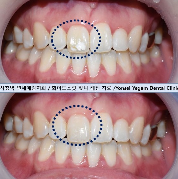 [서울 광화문/남대문] 화이트스팟 레진으로 치료케이스, 비용안내 등등 / 반점치, 반상치 관련 이미지 5