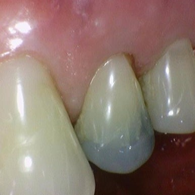 [시청역치과] 미국에서도 크라운 하러 일부러 찾아오는 치과 인증사진 관련 이미지 1
