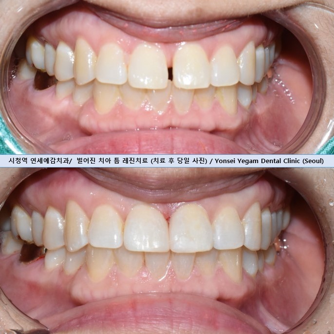 치아 앞니 벌어짐 벌어진 앞니&rarr;레진치료 비용까지 알려드려요 관련 이미지 2