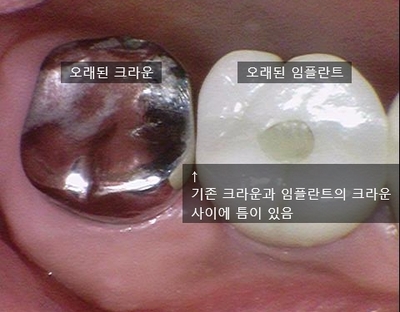 시청역치과 [Q&A]다른치과에서 한 인레이,크라운,임플란트에 음식물이 껴요 관련 이미지 1