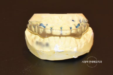 이갈이 소리 안나는 법. 치아 건강과 룸메이트 또는 배우자분의 평안을 위해서! 관련 이미지 4