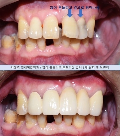 [치과브릿지케이스] 앞니가 너무 많이 흔들려서 발치해야 할 것 같아요 관련 이미지 6