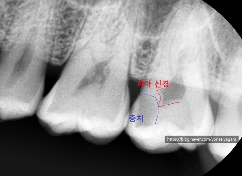 시청역치과 충치치료, 많이 썩었을 때? 신경치료에 대해 알아보아요 관련 이미지 3