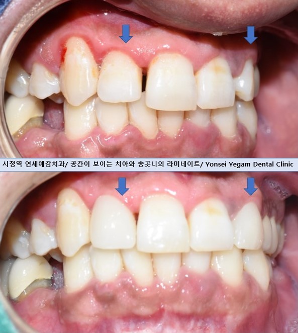 1.송곳니를 다른 앞니 모양 라미네이트로, 2.치아사이 빈공간을 라미네이트로 관련 이미지 8