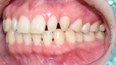 서울 시청역/서울역/ 벌어진 앞니, 왜소치 라미네이트 유명한 치과/ 전후 비교와 가격 관련 이미지 6