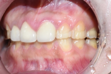 [시청역/광화문] 부식된 노란치아. 정말 하얀, 새하얀 치아로 만들고 싶어요 비용도 알려드려요 관련 이미지 5
