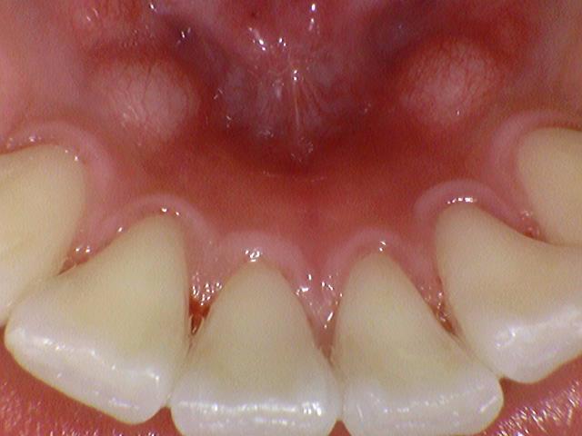 [충정로] 스케일링 흔히 질문하시는 부분에 대한 질문과 답변 Q&A 관련 이미지 2
