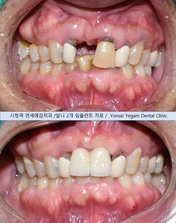 [서울시청역/서울역] 앞니 임플란트 가능할까요? 앞니 내비게이션임플란트 관련 이미지 12