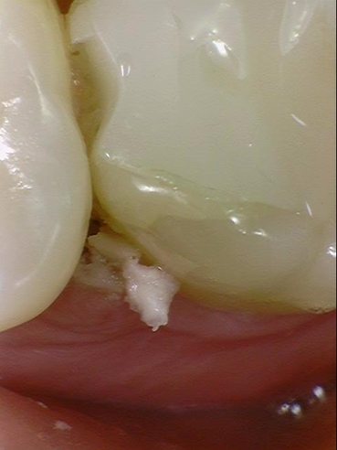 시청역치과 [Q&A]다른치과에서 한 인레이,크라운,임플란트에 음식물이 껴요 관련 이미지 4