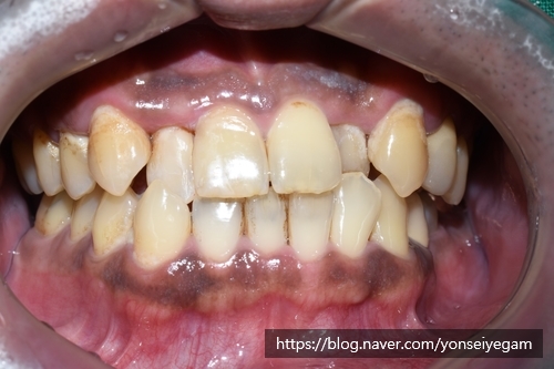 앞니가 너무 많이 썩었어요 앞니 충치치료 관련 이미지 5
