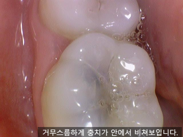[충정로/치과] 인레이해야한다고 진단받으셨나요? 이맥스(세라믹)인레이 실제케이스 같이 살펴보아요 관련 이미지 5