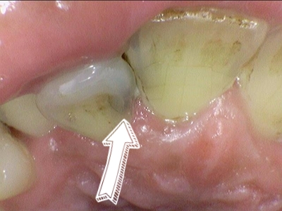 앞니가 너무 많이 썩었어요 앞니 충치치료 관련 이미지 2