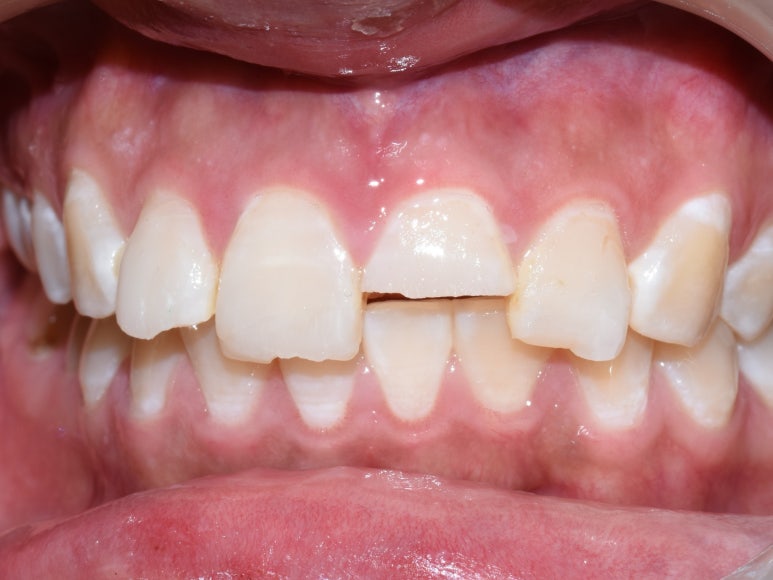 [광화문/연세예감치과] 앞니 치아가 파절되었다면? 앞니 부러짐.레진/크라운/임플란트 관련 이미지 2