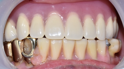 남대문시장가까운치과, 명동,서울역&용산가까운치과, 틀니치료 사례 관련 이미지 19