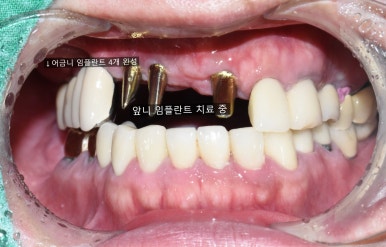 앞니 여러개 임플란트 잘하는 치과 서울역치과 실제사진 관련 이미지 13