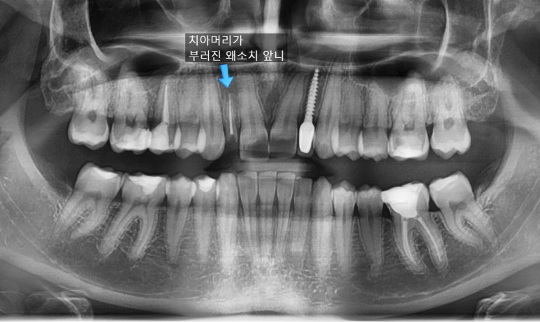 네비게이션임플란트 이용한 앞니 치료 유명한 치과 잔존 유치 케이스 관련 이미지 1