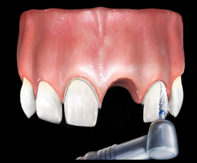 서울시청역 남대문 임플란트 대신에 앞니 브릿지를 한 케이스 관련 이미지 1