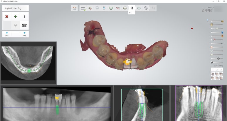 남대문시장 근처 치과 임플란트 연세.예감.치과 관련 이미지 9