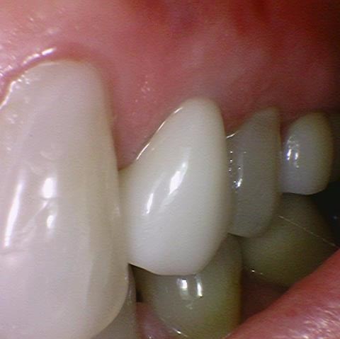 시청역치과, 신경치료 하고 크라운 꼭 해야하나요? 관련 이미지 4