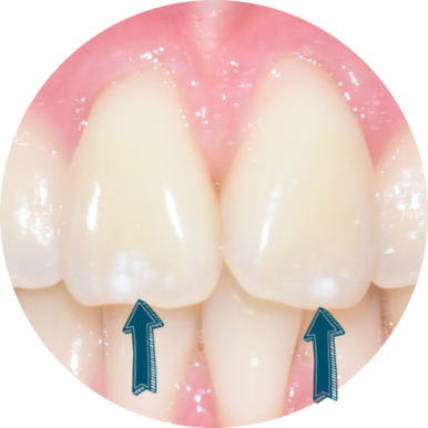 서울시청역 앞니 치아에 갈색 점, 흰색점 치료 전후 관련 이미지 8