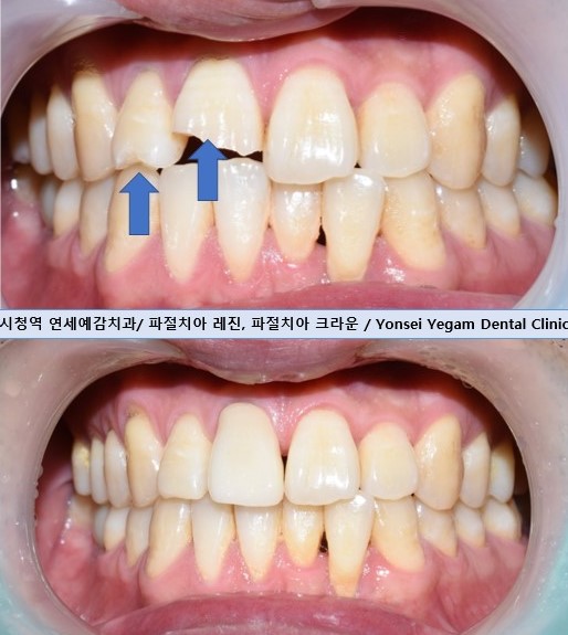 앞니 하나가 부러졌어요 앞니 크라운 앞니 브릿지 관련 이미지 3