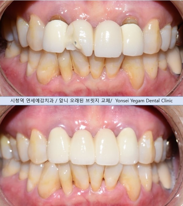 서울시청역 남대문 임플란트 대신에 앞니 브릿지를 한 케이스 관련 이미지 13