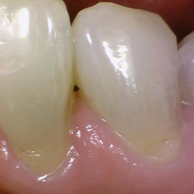 [서울역/시청역] 레진치료 : 화이트스팟(반상치) 케이스 & 치아패임으로 시린 케이스 & 깨진 치아 케이스 관련 이미지 2