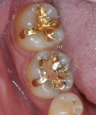 광화문/시청역"까만 아말감, 금니가 보기 싫다면?" 관련 이미지 3