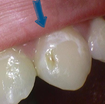 [서울역/시청역] 충치 & 화이트 스팟 (반점치) 의 레진치료케이스 관련 이미지 1