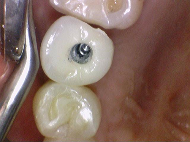 [서울역/광화문] 오래된 크라운에 음식물이 많이 껴요 &rarr;해결방법은? 관련 이미지 1