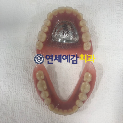 남대문시장가까운치과, 명동,서울역&용산가까운치과, 틀니치료 사례 관련 이미지 5