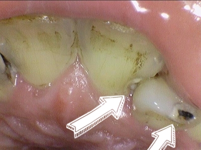 앞니가 너무 많이 썩었어요 앞니 충치치료 관련 이미지 4