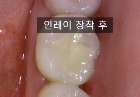 [충정로/치과] 인레이해야한다고 진단받으셨나요? 이맥스(세라믹)인레이 실제케이스 같이 살펴보아요 관련 이미지 9