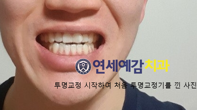 시청역 연세예감 치과 환자분께서 투명교정 후기 남겨주셨어요 관련 이미지 2