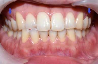 커피많이드세요? 치과에서 하는 치아미백 알려드려요[효과, 유지 등등 실제사례] 관련 이미지 5