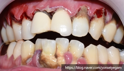 잇몸질환 평생 걱정안합니다??? 관련 이미지 3