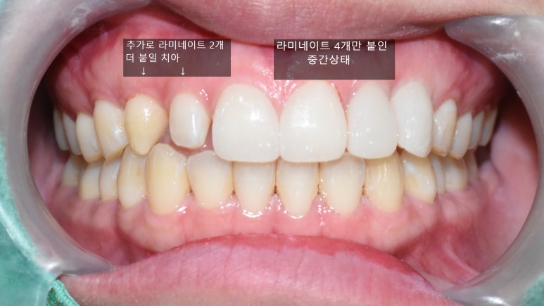 서울 시청역/서울역/ 벌어진 앞니, 왜소치 라미네이트 유명한 치과/ 전후 비교와 가격 관련 이미지 10