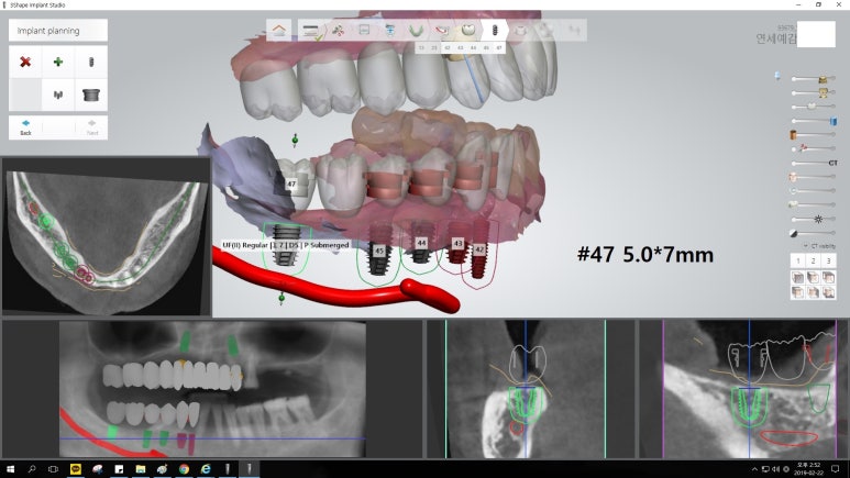[남대문시장] 임플란트 조금 더 안아프고 간편하게 관련 이미지 14