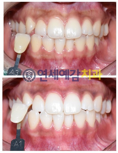 서울에서 치아미백 하는 치과 찾고 계신가요? 해외에서도 미백하러 오는 시청역 치과 미백비용 관련 이미지 5