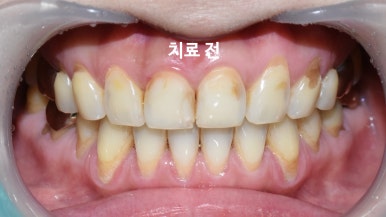 충정로치과,을지로치과/ 치아뿌리쪽이 패이고 부식된 것처럼 누렇게 보인 치경부 마모 레진 치료 증례 관련 이미지 4