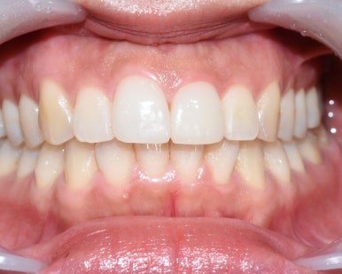 라미네이트 2개이상시 개당 50만원(부가세별도) 깨진 앞니 최소삭제한 라미네이트 케이스 관련 이미지 2