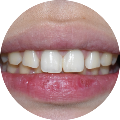벌어진 앞니 치료, 하루에 가능, 실제케이스 및 가격 비용 관련 이미지 3