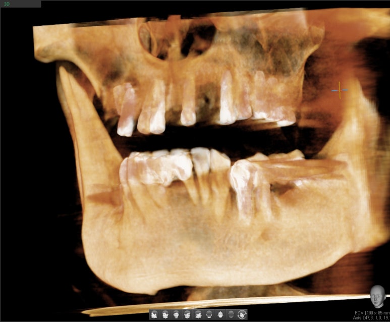 [임플란트/서울역] 서울 상악 전체인플란트 실제사례.극한의 케이스도 관련 이미지 7